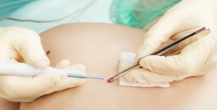 eletrocauterização single