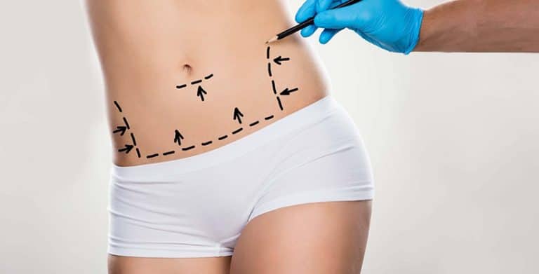 Lipoaspiração