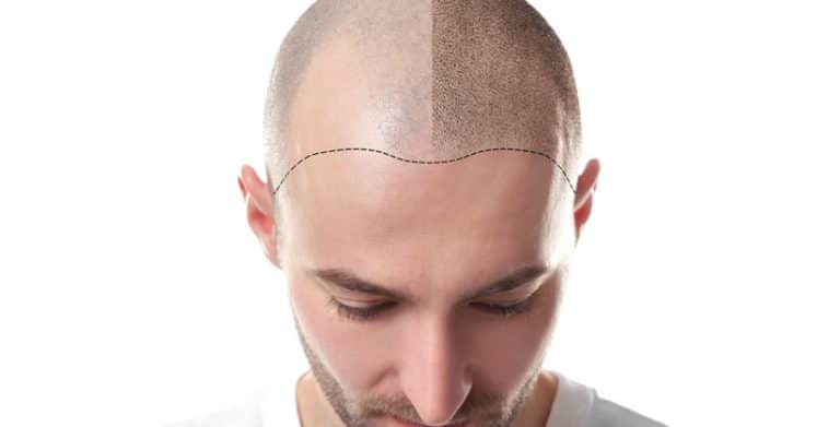 transplante capilar single