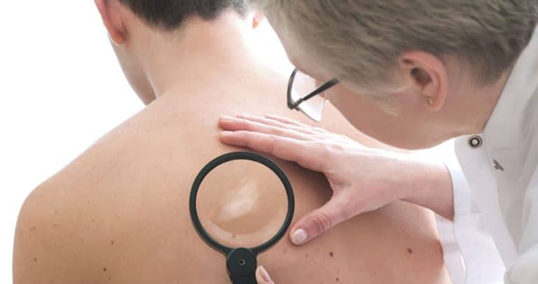 Blog 39 Hanseníase pode ser tratada em qualquer unidade de saúde