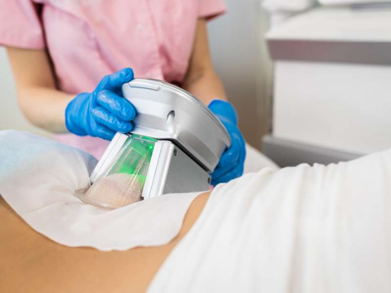 aplicador sendo colocado na área abdominal para um tratamento de criolipólise