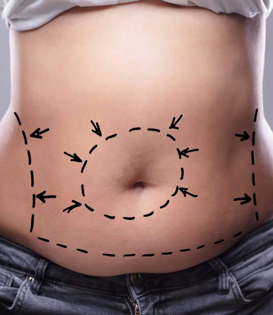 ABDOMINOPLASTIA para quem e recomendado 2