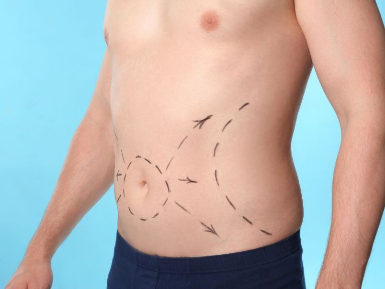 Lipoescultura para Homens 1