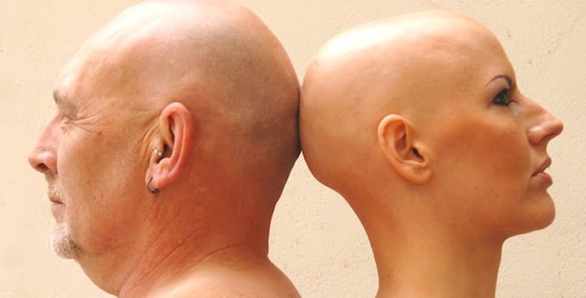 TRATAMENTO ALOPECIA AREATA BRASÍLIA - DF
