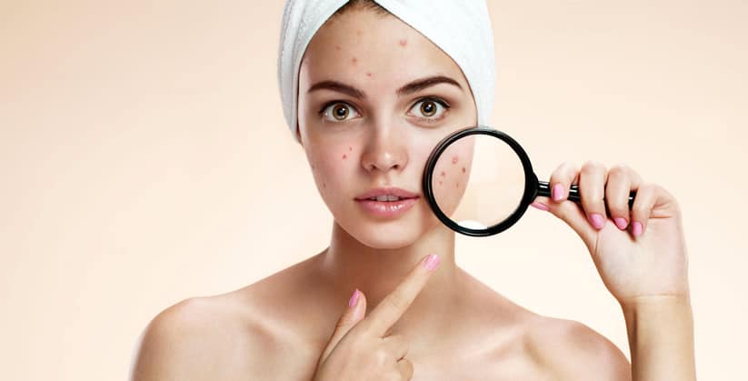 TRATAMENTO DE ACNE BRASILIA