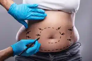 Lipoaspiração: cuidados pós-cirurgia.