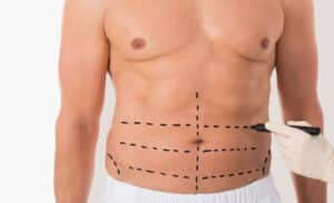 Quem pode se beneficiar da lipoescultura?