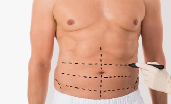 Quem pode se beneficiar da lipoescultura?