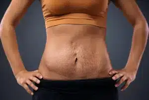Abdominoplastia