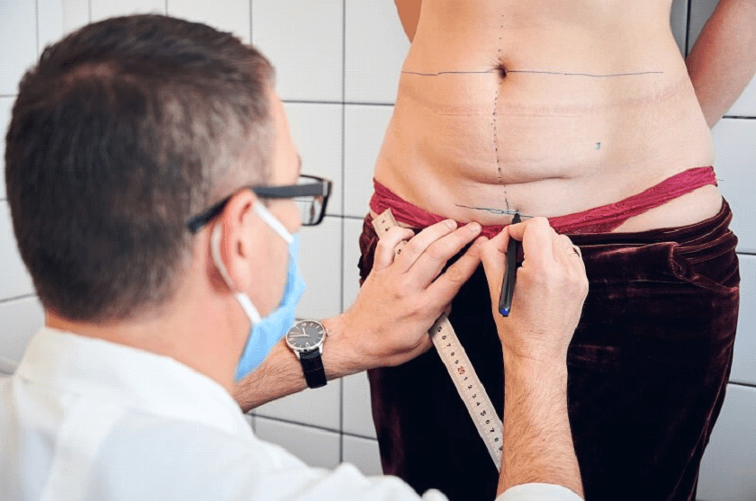 A lipoaspiração é um procedimento indicado para remoção do excesso de gordura de determinadas regiões do corpo