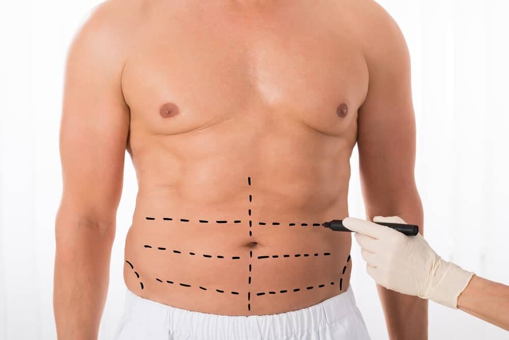 abdominoplastia masculina preço