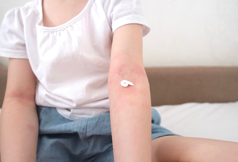 As coceiras causam dificuldade para dormir