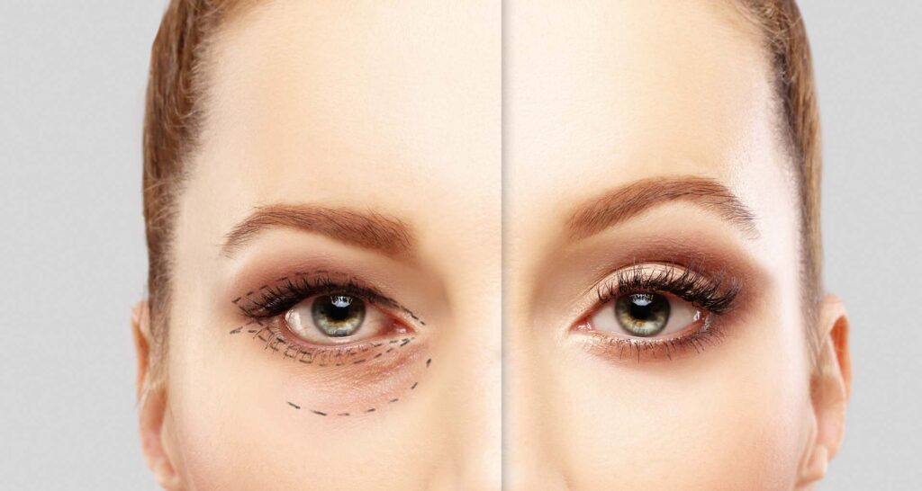 blefaroplastia