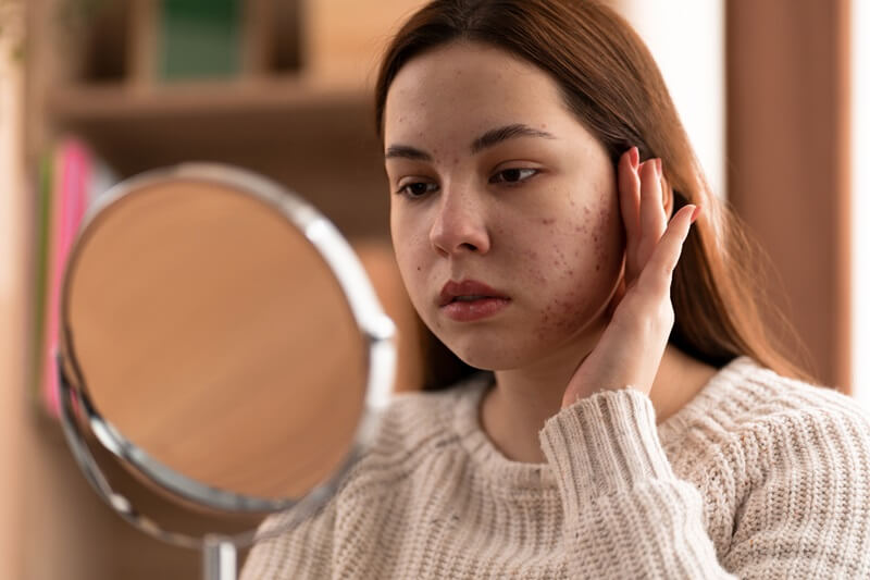 Cicatrizes de Acne: Como Tratá-las e Reduzir sua Aparência 1 prevenir cicatrizes de acne