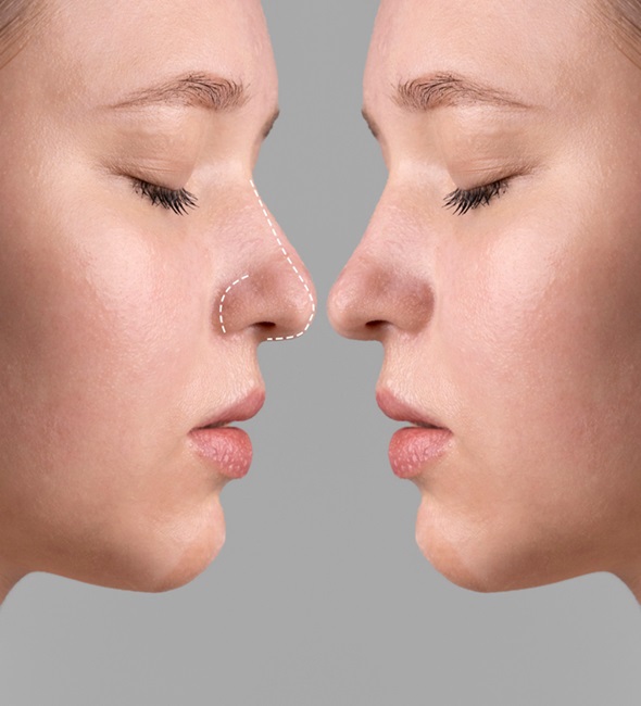 tipos de rinoplastia