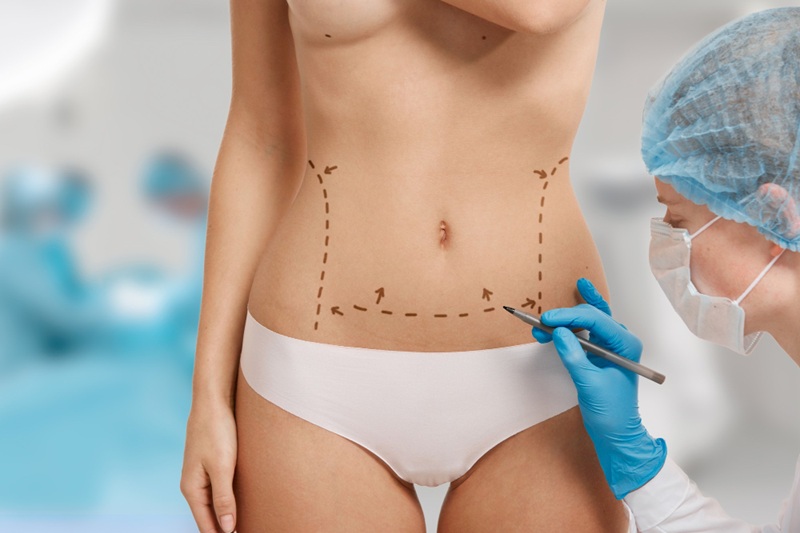 ABDOMINOPLASTIA EM BRASILIA 1